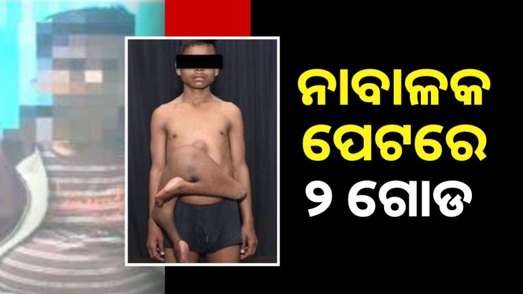 ବିରଳ ଅସ୍ତ୍ରୋପଚାର: ନାବାଳକ ଠାରୁ ଅଲଗା ହେଲା ପାରାସାଇଟିକ୍ ଟ୍ୱିନ୍